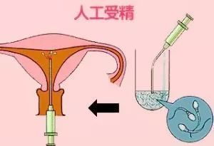 试管婴儿