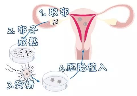 试管婴儿过程