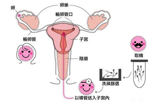 试管婴儿