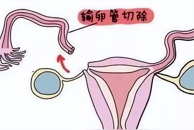 试管婴儿移植